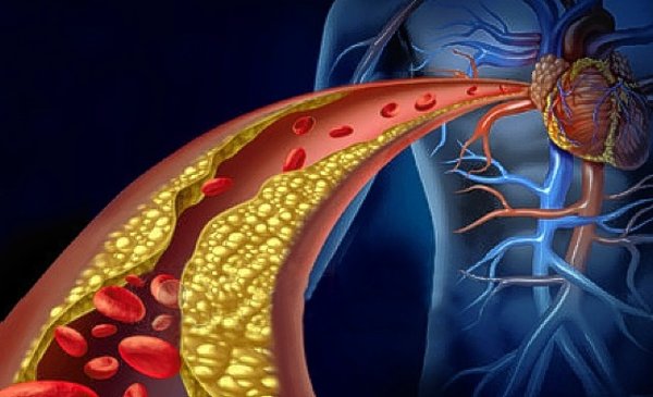 Nuevos Tratamientos Frente A La Obstrucción De Arterias